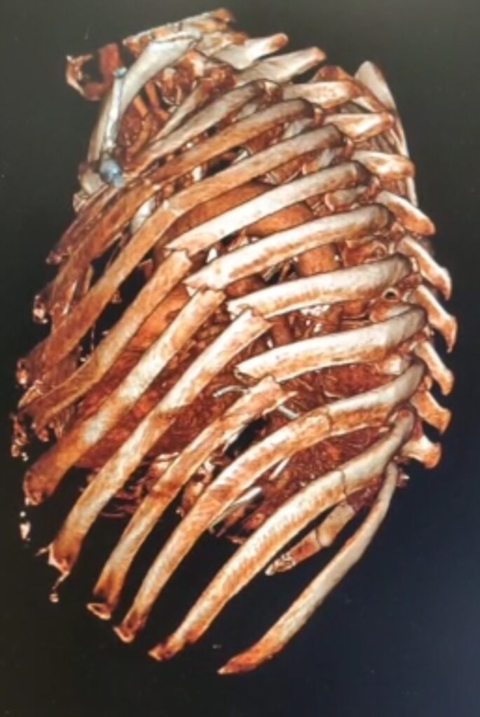 Manchester Cadaveric Rib Fracture Course – www.orthocycle.org